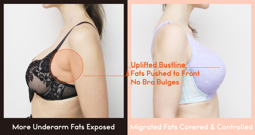 Breast Tissue Migration: Fact or Fiction? - Lingerie Briefs ~ by